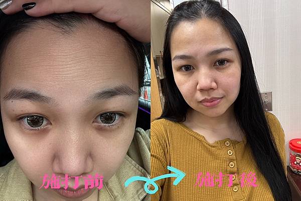 【醫美】肉毒桿菌除額頭細紋；告別抬頭紋 再現平滑額頭X桃園彥
