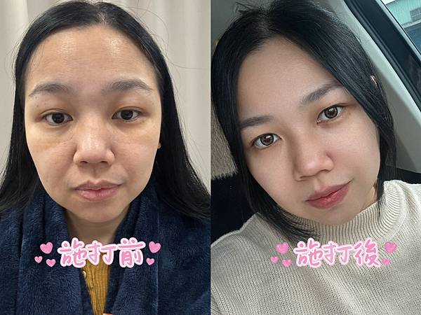 【醫美】玻尿酸填淚溝、印地安紋：改善眼周老化，重拾年輕光彩