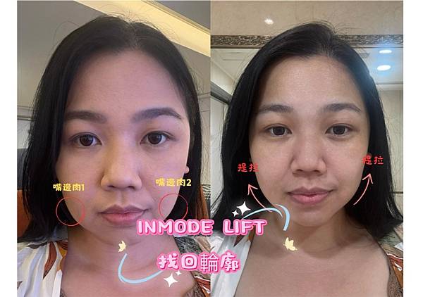 不開刀的拉提術之拯救鱈寶媽的圓臉｜ INMODE LIFT 
