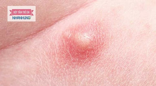 Cách Trị Mụn Nhọt Ở Vùng Kín: Cách Trị Mụn Nhọt Ở Vùng Kín: