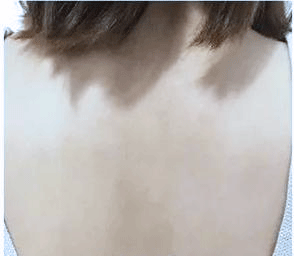 背部痘痘、背部粉刺保養推薦