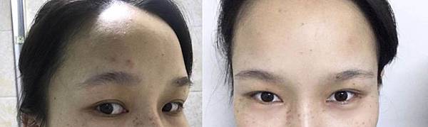 淡孕斑、美白、懷孕痘痘、消痘疤平價精華液