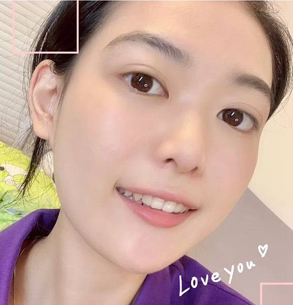 消痘疤、下巴痘、人中痘、額頭痘、生理痘保養