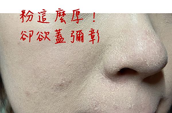 40歲保養方式淡斑、痘疤、雀斑