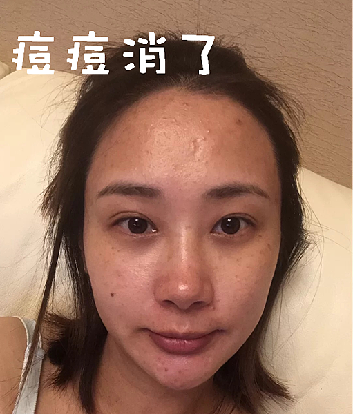 懷孕痘痘、消痘疤、下巴痘、人中痘、額頭痘保養