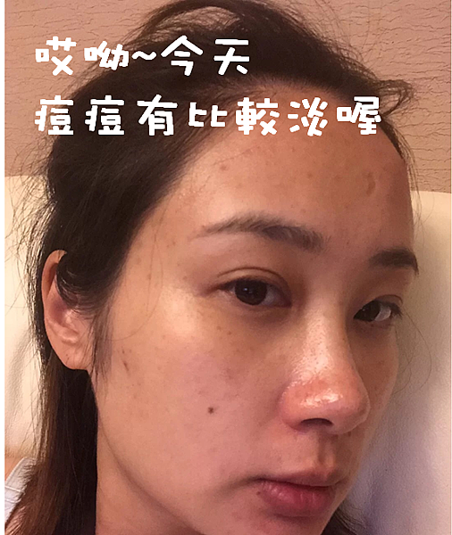 懷孕痘痘、消痘疤、下巴痘、人中痘、額頭痘保養