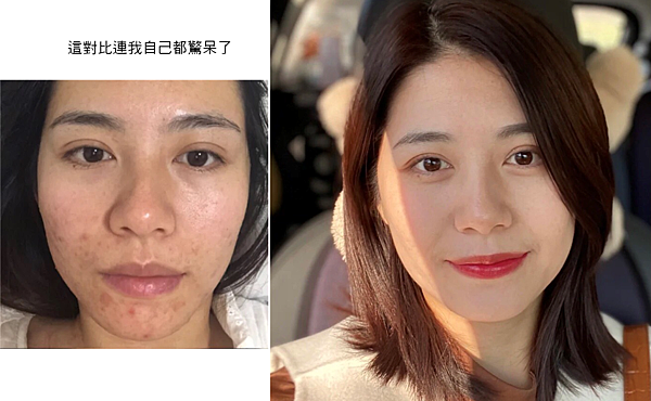 懷孕痘痘肌密能量水