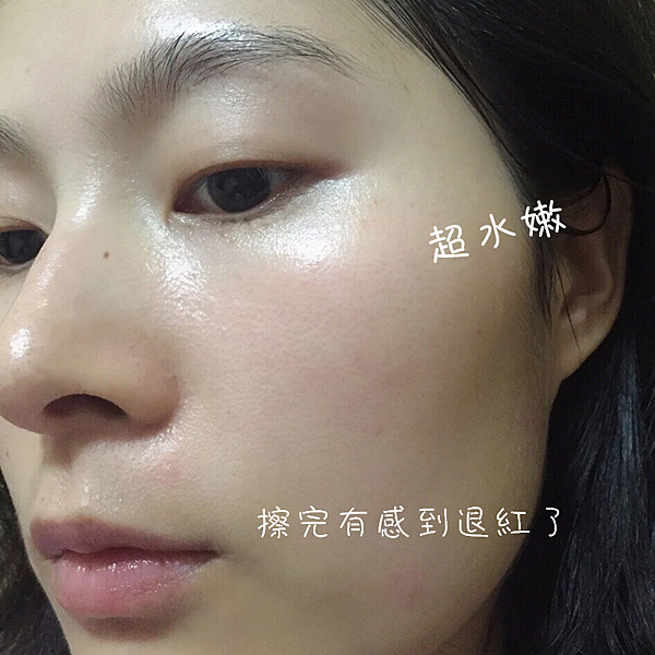 敏感肌保養推薦 酒糟皮膚炎