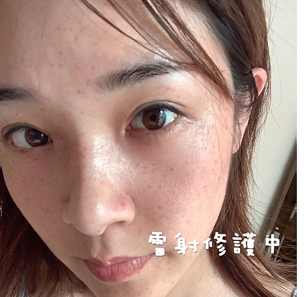 雷射修護、除斑術後、點痣、敏感肌肌華液推薦