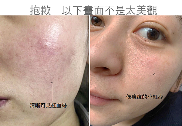 女人皮膚薄過敏有紅血絲紅疹