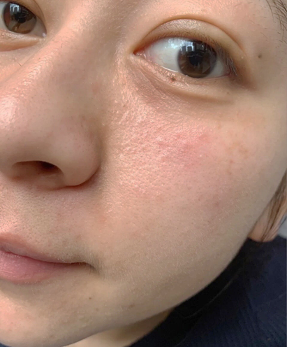 皮膚過敏有什麼保養推薦