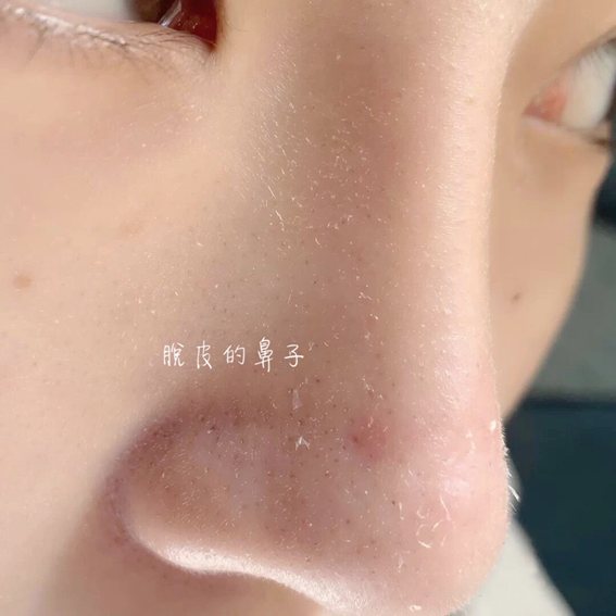 過敏鼻子脫皮保養推薦、脫皮卡粉怎麼辦急救精華液