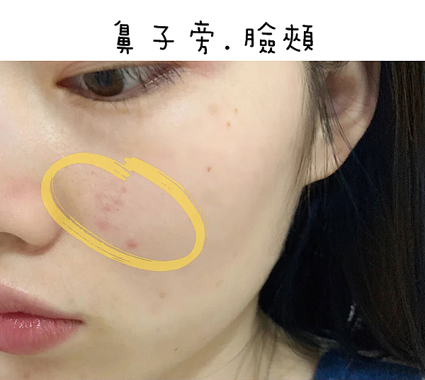 額頭痘痘、下巴痘痘、生理痘、口罩痘、油性敏感肌的私房保養清單