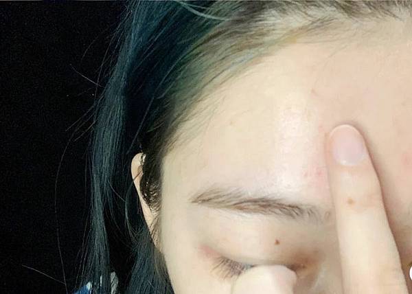 額頭痘痘、下巴痘痘、生理痘、口罩痘、油性敏感肌的私房保養清單