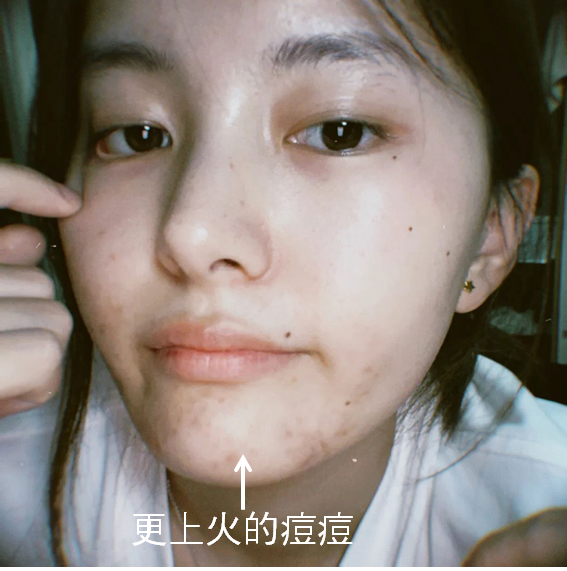 下巴痘痘、痘疤、暗沉生理痘、壓力痘精華液推薦，淡斑、毛孔粗大、粉刺、痘疤就靠肌密能量水