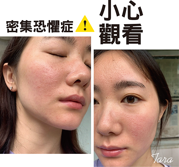 敏感肌、酒糟肌、臉潮紅清爽保養推薦