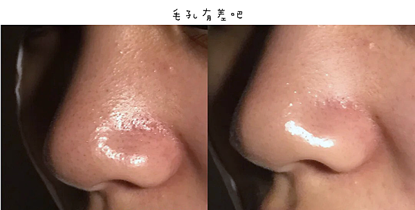 毛孔粗大、粉刺、痘疤、出油保養群組推薦