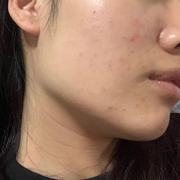 毛孔粗大、粉刺、痘疤、出油保養群組推薦