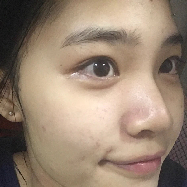 毛孔粗大、粉刺、痘疤、出油保養群組推薦