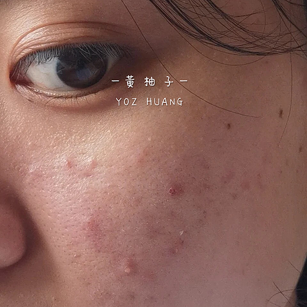 除痘疤、粉刺、毛孔粗大改善最有感精華液