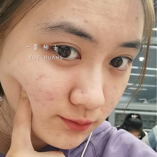 除痘疤、粉刺、毛孔粗大改善最有感精華液