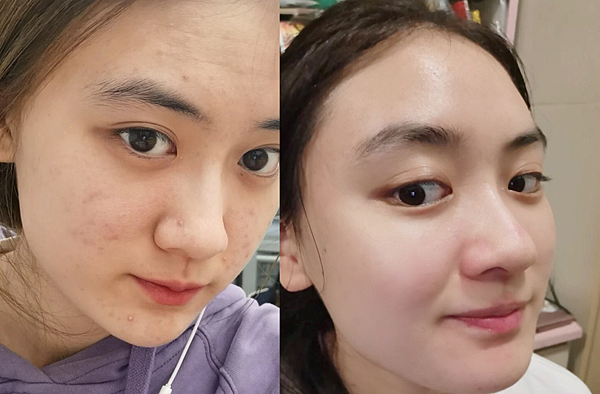 除痘疤、粉刺、毛孔粗大改善最有感精華液