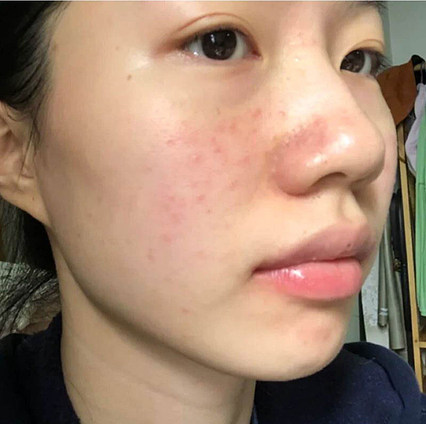 運動後肌膚乾燥泛紅？敏感肌必推-療癒小藍瓶「ATLA肌密青春原液」