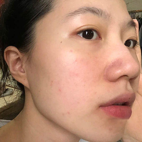 運動後肌膚乾燥泛紅？敏感肌必推-療癒小藍瓶「ATLA肌密青春原液」