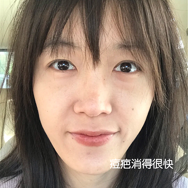 40歲長痘痘、下巴生理痘、消痘疤、美白淨膚保養推薦