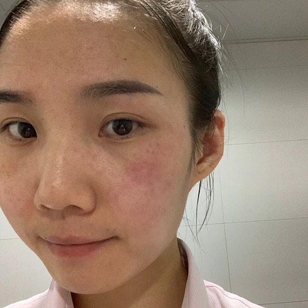脂漏皮膚炎保養推薦