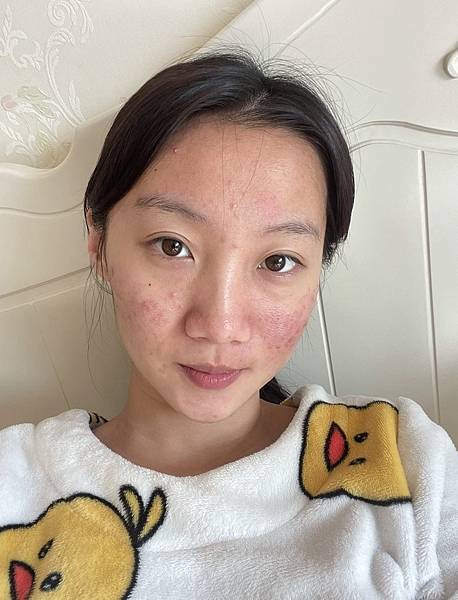 大夜班女孩兒的保養，痘痘、粉刺失控怎麼辦？！