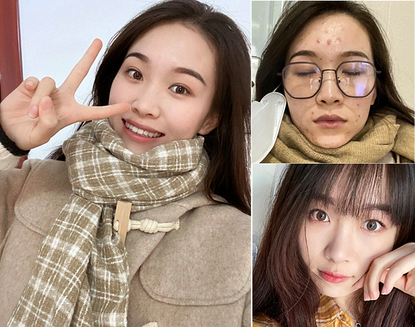 30歲生理痘、消痘疤、額頭痘痘、口罩痘精華液推薦