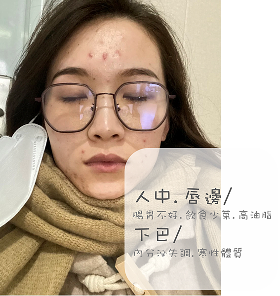 30歲生理痘、消痘疤、額頭痘痘、口罩痘精華液推薦