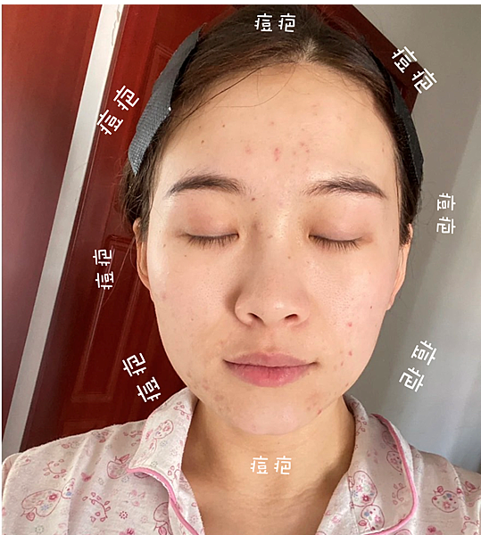 30歲生理痘、消痘疤、額頭痘痘、口罩痘精華液推薦