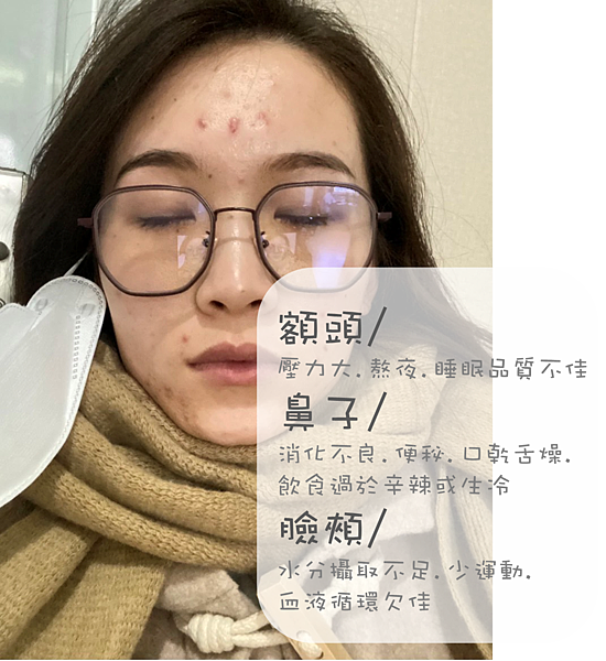 30歲生理痘、消痘疤、額頭痘痘、口罩痘精華液推薦