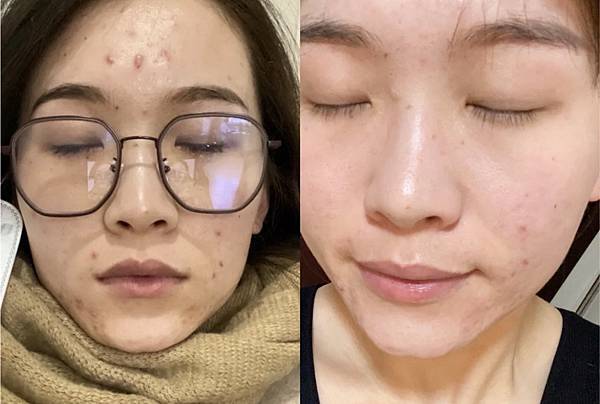 30歲生理痘、消痘疤、額頭痘痘、口罩痘精華液推薦