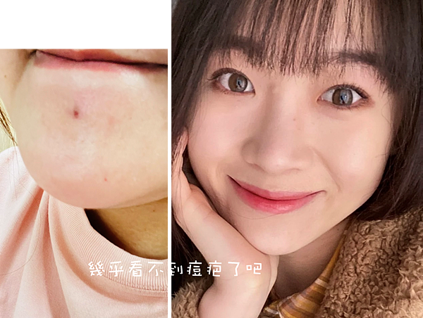 30歲生理痘、消痘疤、額頭痘痘、口罩痘精華液推薦