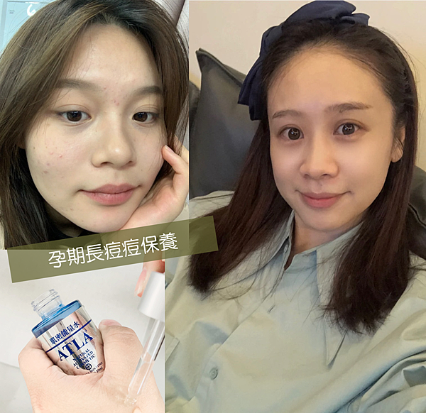 懷孕護膚分享，長痘痘、皮膚粗糙
