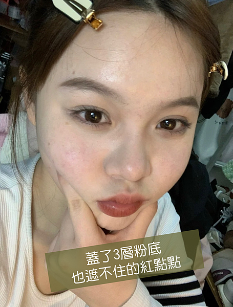 懷孕護膚分享，長痘痘、皮膚粗糙必試試ATLA小藍瓶