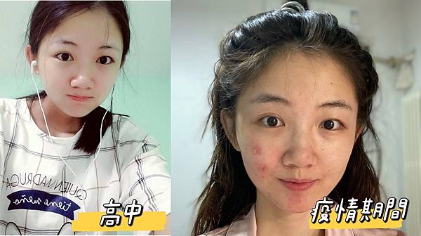 口罩痘、消痘疤、下巴痘、人中痘、額頭痘、生理痘，最有感消痘經驗分享-ATLA肌密能量水