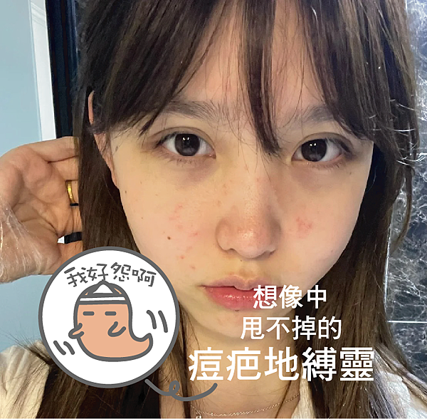 毛孔粗大、消痘疤、T字出油、下巴痘、人中痘、額頭痘保養