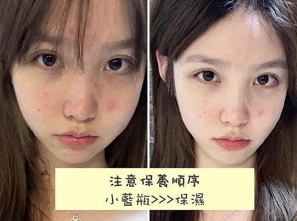 毛孔粗大、消痘疤、T字出油、下巴痘、人中痘、額頭痘保養