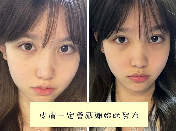 毛孔粗大、消痘疤、T字出油、下巴痘、人中痘、額頭痘保養