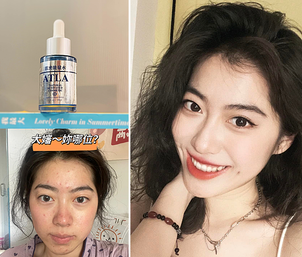 告別痘痘肌！告別毛孔粗大！油臉人如何保養？不藏私愛用品分享