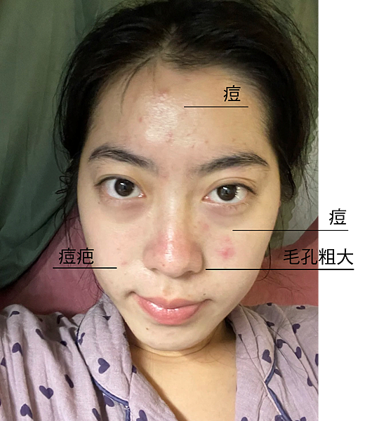 告別痘痘肌！告別毛孔粗大！油臉人如何保養？不藏私愛用品分享