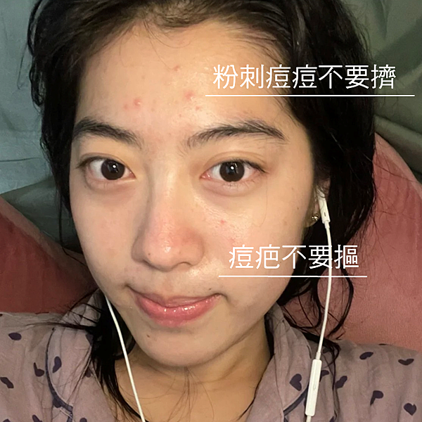 告別痘痘肌！告別毛孔粗大！油臉人如何保養？不藏私愛用品分享