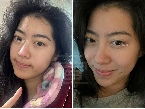 告別痘痘肌！告別毛孔粗大！油臉人如何保養？不藏私愛用品分享