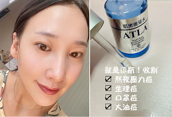 團購很燒的痘痘保養分享~擦的淨膚【ATLA肌密能量水】收割熬夜壓力痘、生理痘、口罩痘、大油痘真的服！