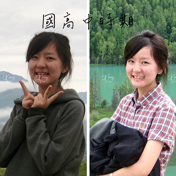 (文長)長痘痘的都該看，我的15年痘疤凹洞痘坑修護心路歷程