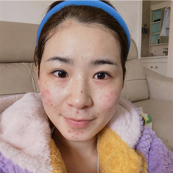新秘推薦拍婚紗婚禮前保養「ATLA肌密青春原液」 結婚前壓力大一直冒痘痘怎麼辦,保養先求穩再求好,新秘推薦的新